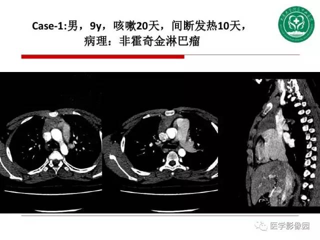 【PPT】纵隔肿瘤的影像检查规范及诊断思路