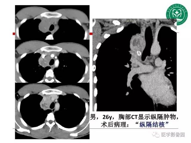 【PPT】纵隔肿瘤的影像检查规范及诊断思路