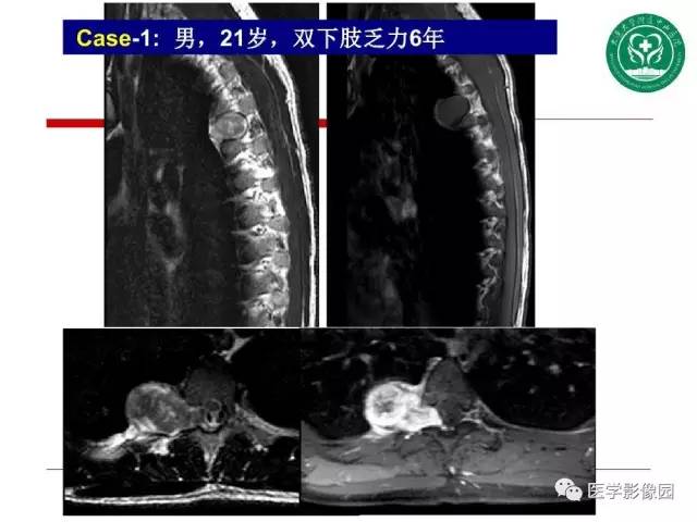 【PPT】纵隔肿瘤的影像检查规范及诊断思路
