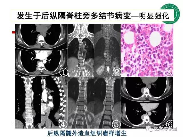 【PPT】纵隔肿瘤的影像检查规范及诊断思路