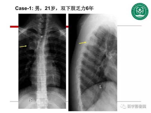 【PPT】纵隔肿瘤的影像检查规范及诊断思路
