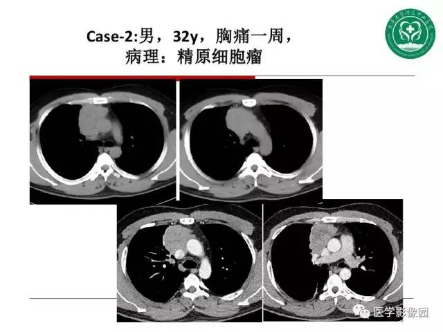 【PPT】纵隔肿瘤的影像检查规范及诊断思路