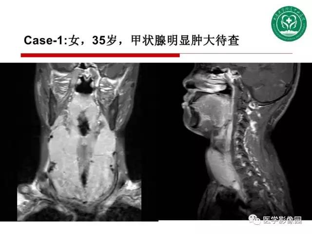 【PPT】纵隔肿瘤的影像检查规范及诊断思路