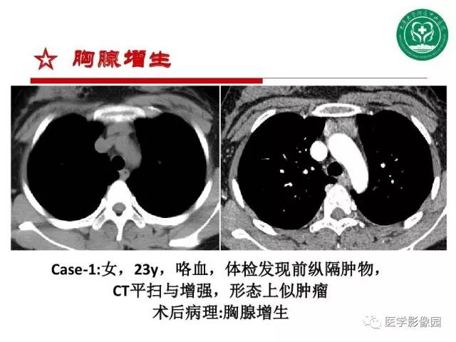 【PPT】纵隔肿瘤的影像检查规范及诊断思路
