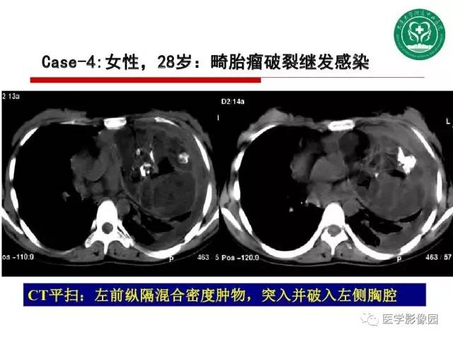 【PPT】纵隔肿瘤的影像检查规范及诊断思路