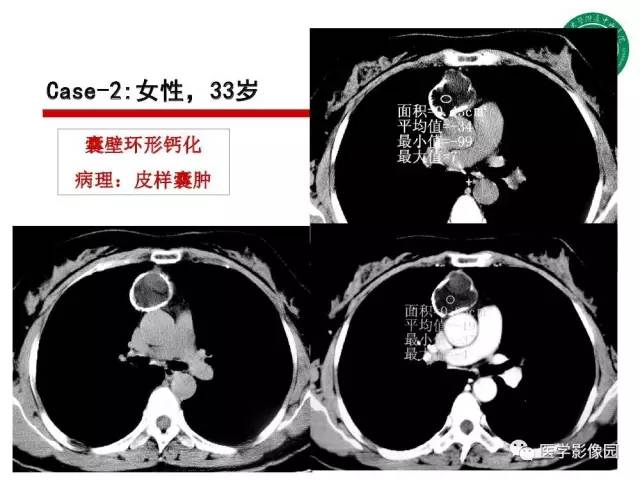【PPT】纵隔肿瘤的影像检查规范及诊断思路