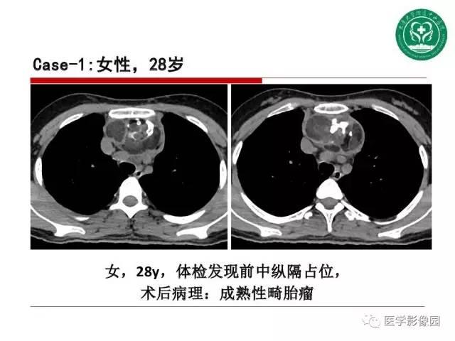 【PPT】纵隔肿瘤的影像检查规范及诊断思路