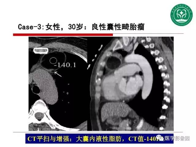 【PPT】纵隔肿瘤的影像检查规范及诊断思路