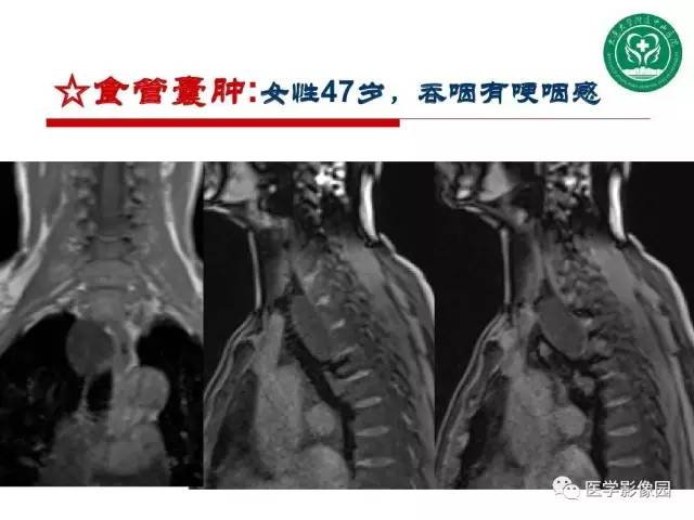 【PPT】纵隔肿瘤的影像检查规范及诊断思路