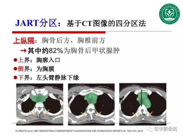 【PPT】纵隔肿瘤的影像检查规范及诊断思路