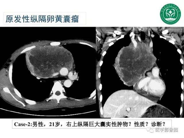 【PPT】纵隔肿瘤的影像检查规范及诊断思路