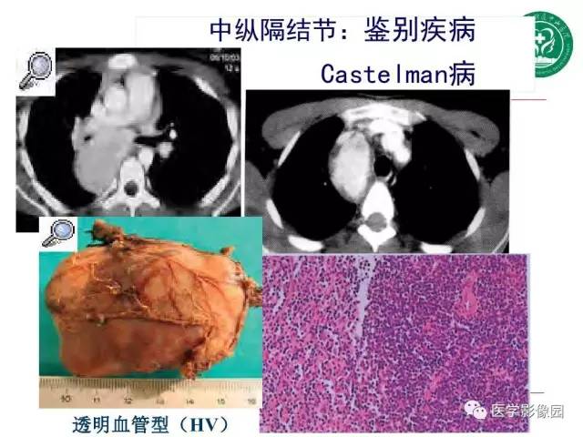 【PPT】纵隔肿瘤的影像检查规范及诊断思路
