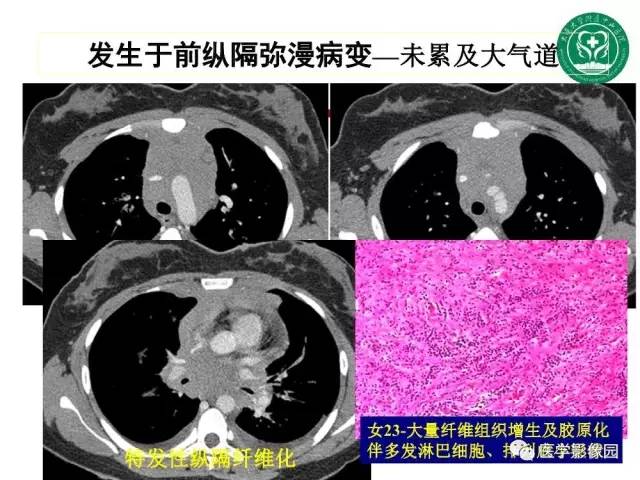 【PPT】纵隔肿瘤的影像检查规范及诊断思路