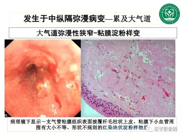【PPT】纵隔肿瘤的影像检查规范及诊断思路