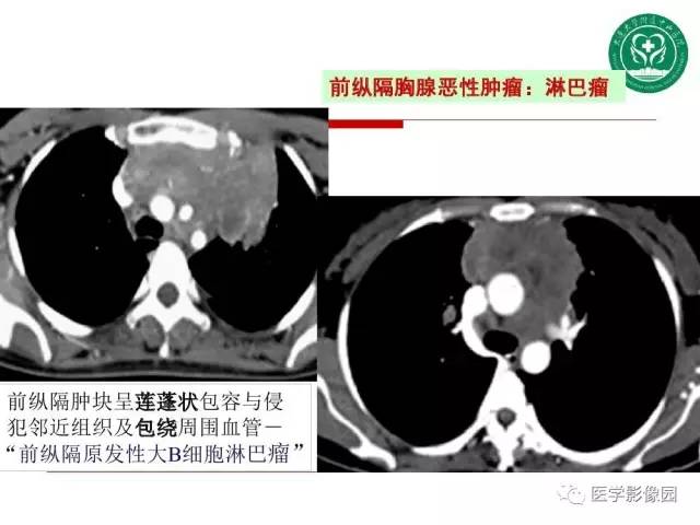 【PPT】纵隔肿瘤的影像检查规范及诊断思路