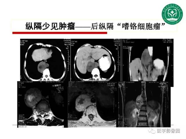 【PPT】纵隔肿瘤的影像检查规范及诊断思路