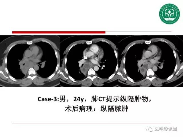 【PPT】纵隔肿瘤的影像检查规范及诊断思路