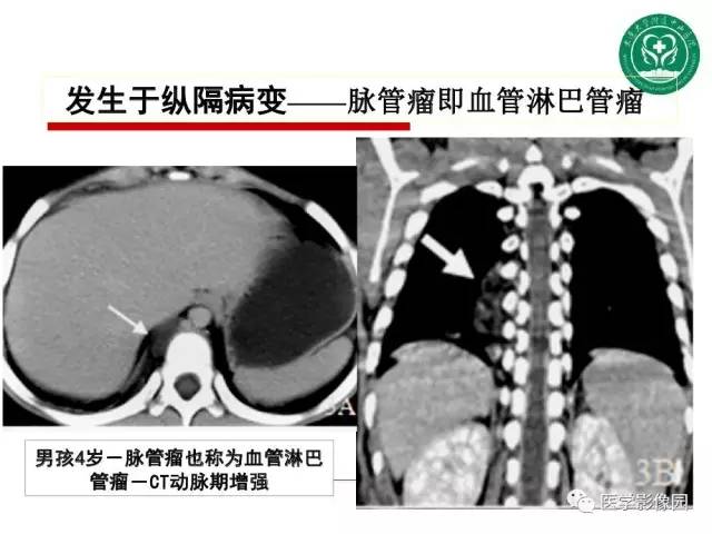 【PPT】纵隔肿瘤的影像检查规范及诊断思路