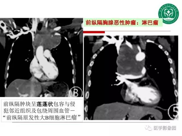 【PPT】纵隔肿瘤的影像检查规范及诊断思路