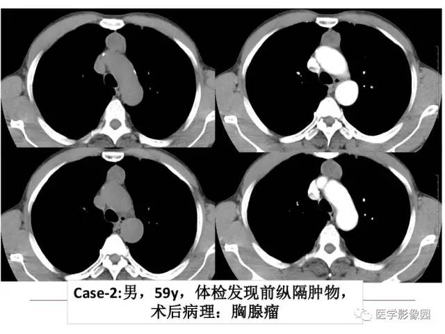 【PPT】纵隔肿瘤的影像检查规范及诊断思路
