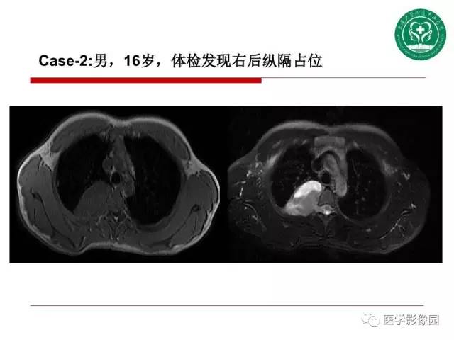 【PPT】纵隔肿瘤的影像检查规范及诊断思路