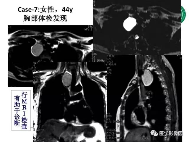 【PPT】纵隔肿瘤的影像检查规范及诊断思路