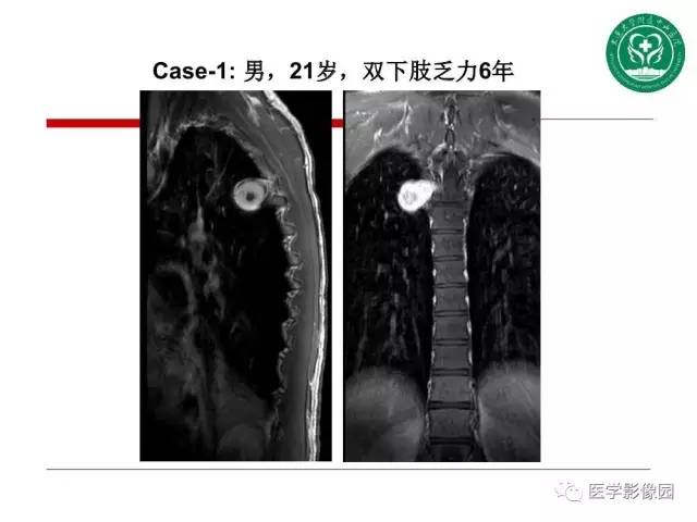 【PPT】纵隔肿瘤的影像检查规范及诊断思路