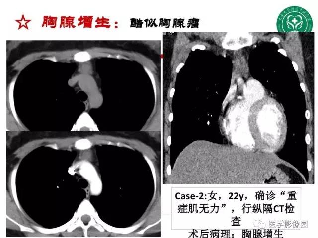 【PPT】纵隔肿瘤的影像检查规范及诊断思路