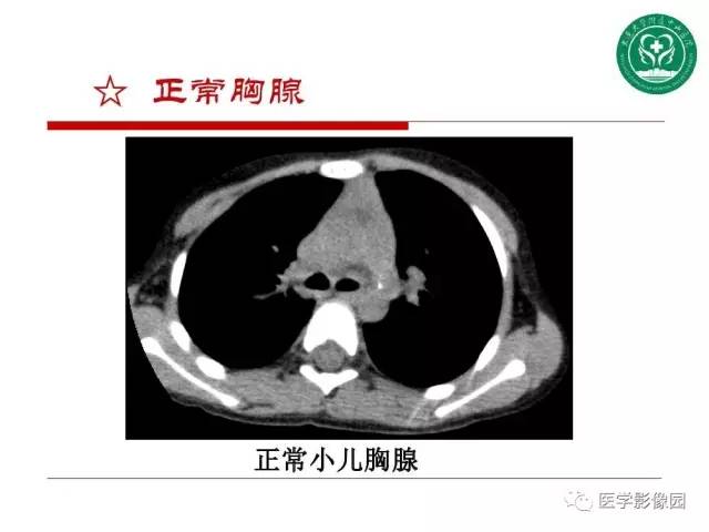 【PPT】纵隔肿瘤的影像检查规范及诊断思路