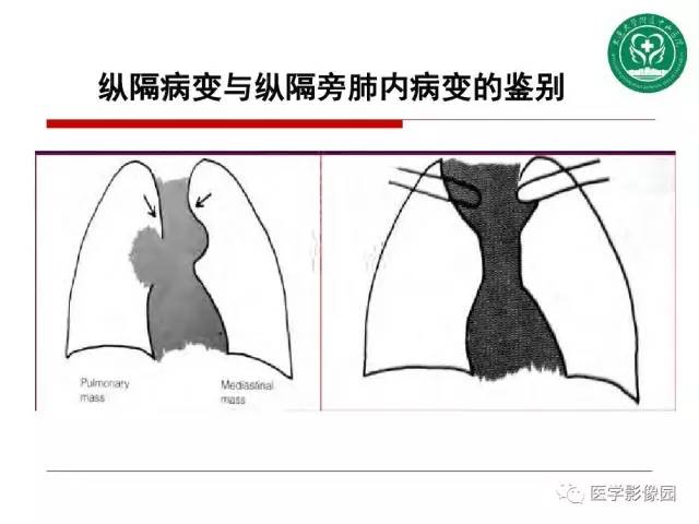 【PPT】纵隔肿瘤的影像检查规范及诊断思路