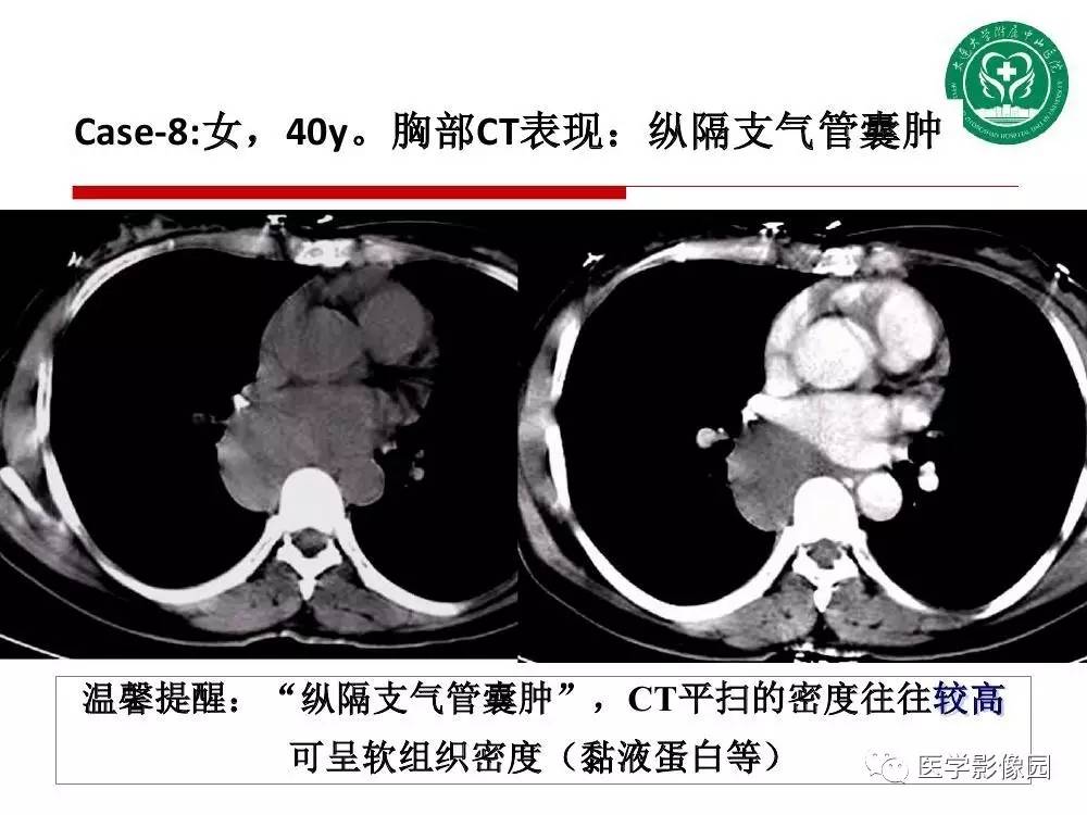 【PPT】纵隔肿瘤的影像检查规范及诊断思路