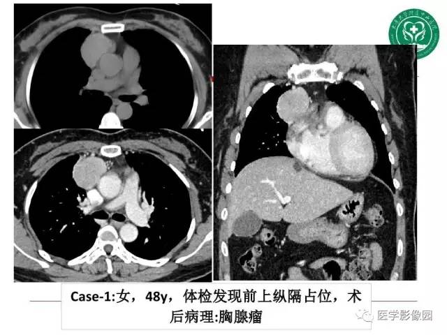 【PPT】纵隔肿瘤的影像检查规范及诊断思路