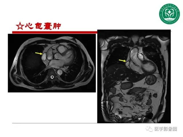 【PPT】纵隔肿瘤的影像检查规范及诊断思路