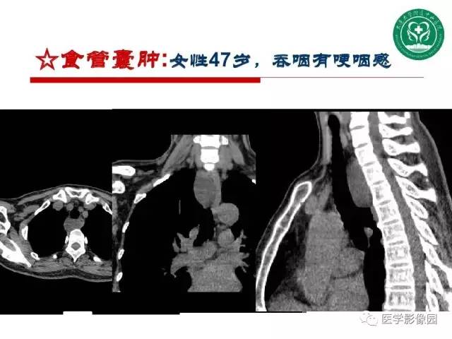 【PPT】纵隔肿瘤的影像检查规范及诊断思路