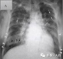 “克氏线征” 的影像表现与临床意义