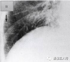 “克氏线征” 的影像表现与临床意义