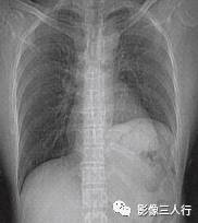 “横膈矛盾运动征” 的影像表现与临床意义