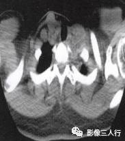 “横膈矛盾运动征” 的影像表现与临床意义