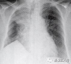 “膈上尖峰征” 的影像表现与临床意义