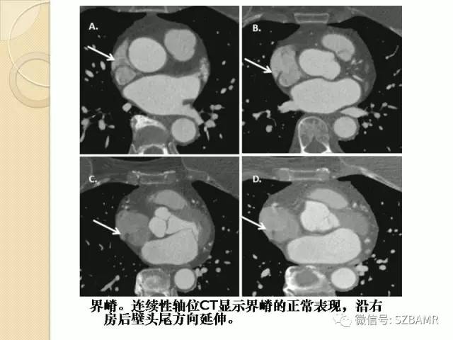 【PPT】心脏肿块CT诊断