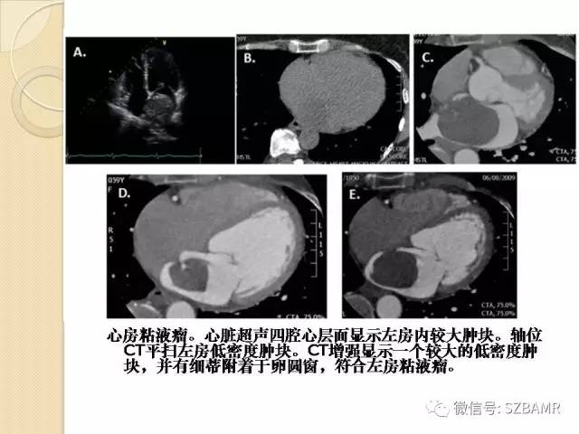 【PPT】心脏肿块CT诊断