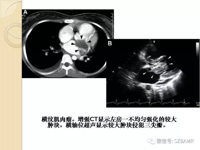 【PPT】心脏肿块CT诊断