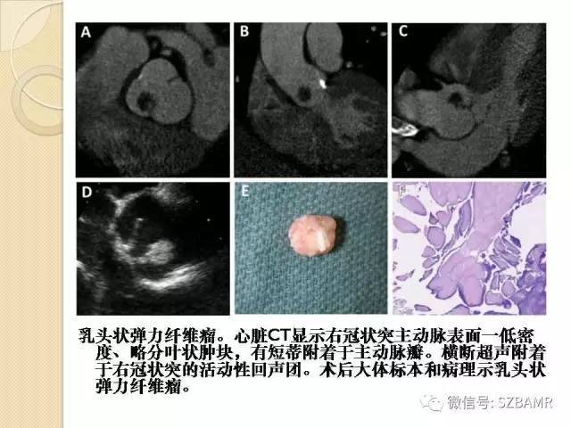 【PPT】心脏肿块CT诊断