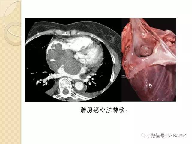 【PPT】心脏肿块CT诊断