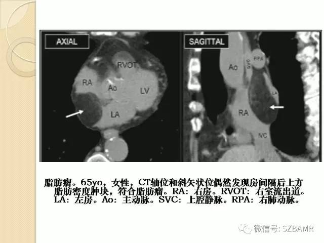 【PPT】心脏肿块CT诊断