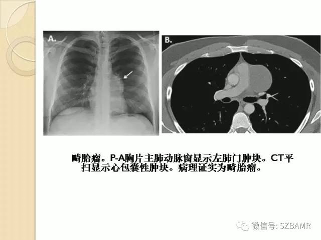 【PPT】心脏肿块CT诊断