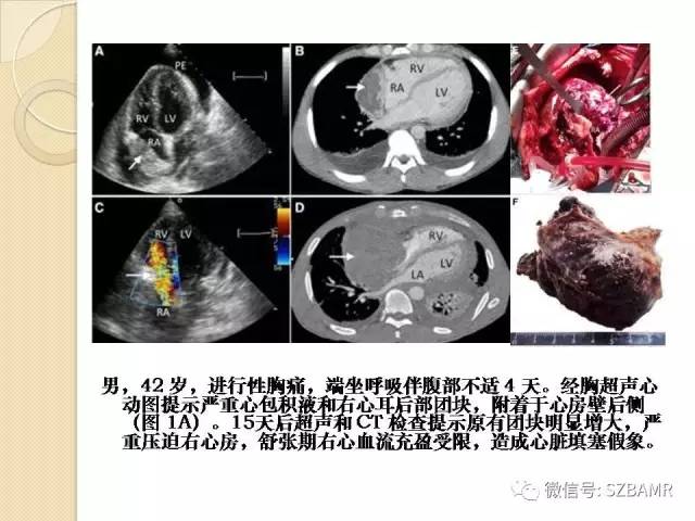 【PPT】心脏肿块CT诊断