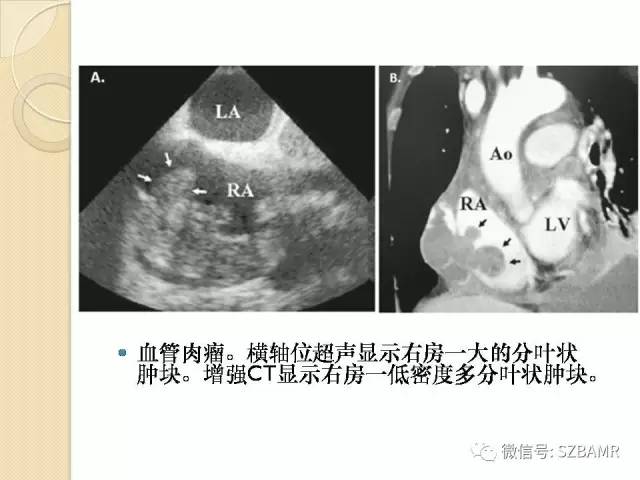 【PPT】心脏肿块CT诊断