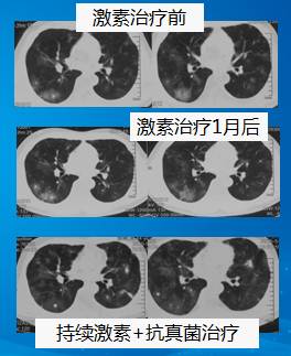 【病例】肺部真菌感染(毛霉菌肺炎)1例CT影像表现 【病例】肺部真菌感染(毛霉菌肺炎)1例CT影像表现