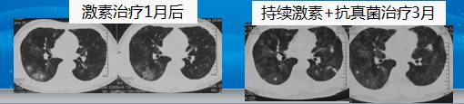 【病例】肺部真菌感染(毛霉菌肺炎)1例CT影像表现 【病例】肺部真菌感染(毛霉菌肺炎)1例CT影像表现